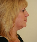 Feel Beautiful - Necklift San Diego Case 14 - Before Photo